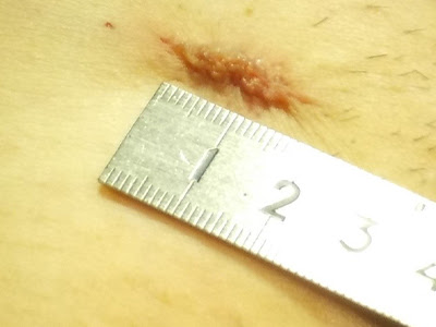 前立腺がん術後の鼠径ヘルニアのアイキャッチ画像