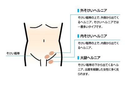 鼠径ヘルニアの原因のアイキャッチ画像